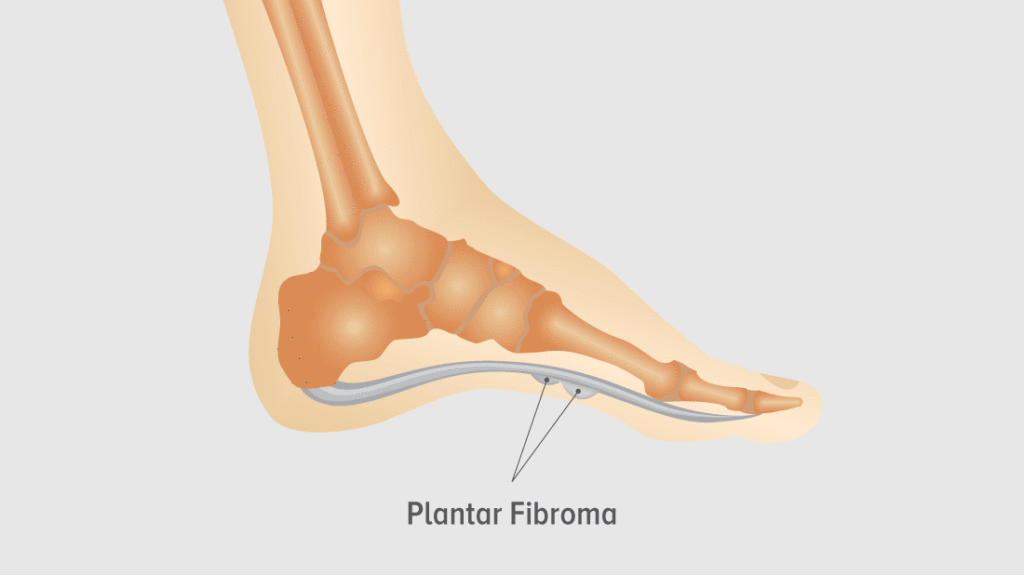 plantarfibromafoot Relieve Foot Pain & Leg Pain