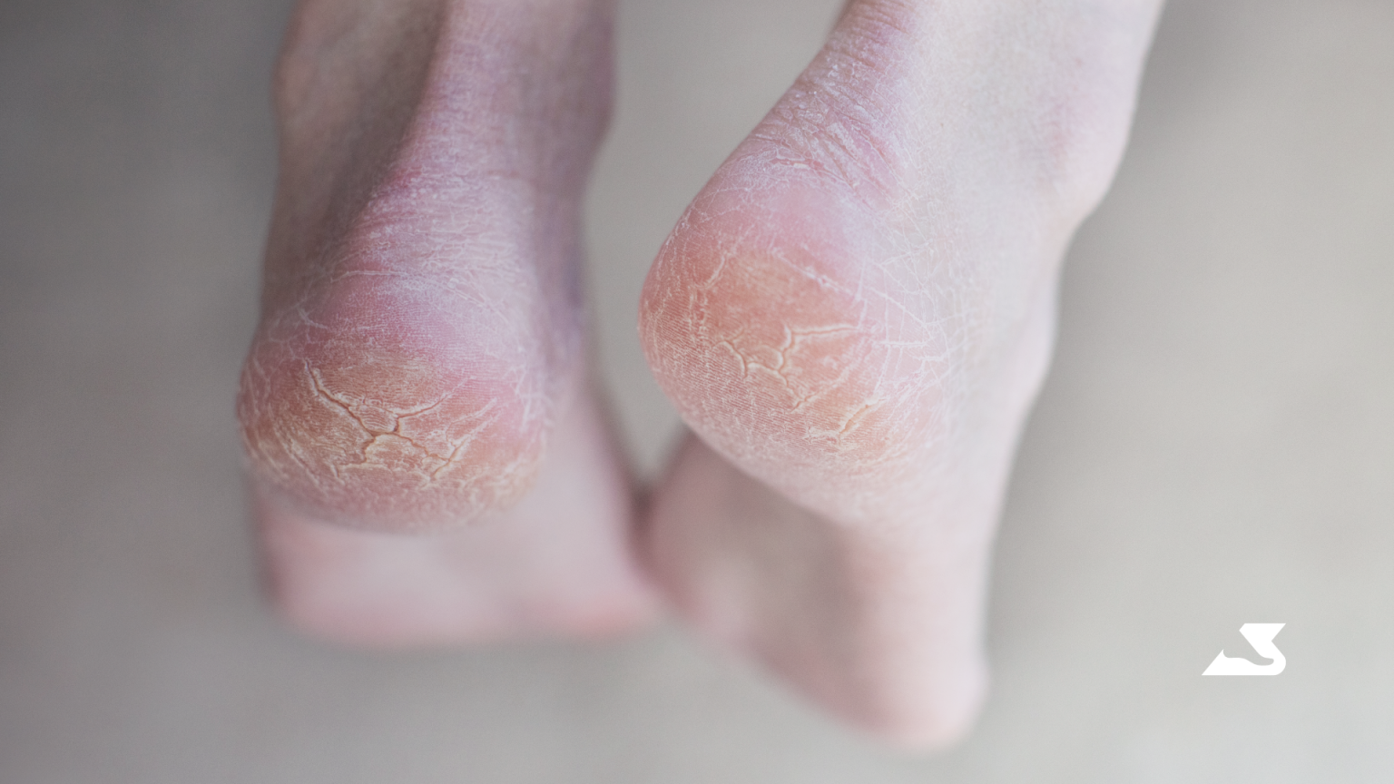 Cracked Heels During Winter Months – BioPed Footcare