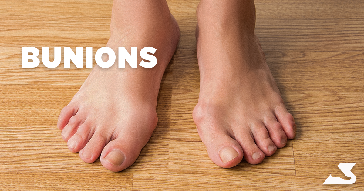 Everything To Know About Bunions (Hallux Valgus) – BioPed Footcare