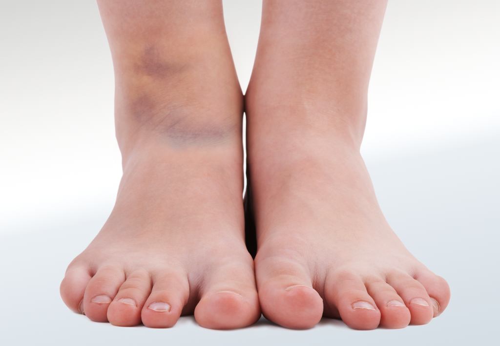 Sprain/Strain