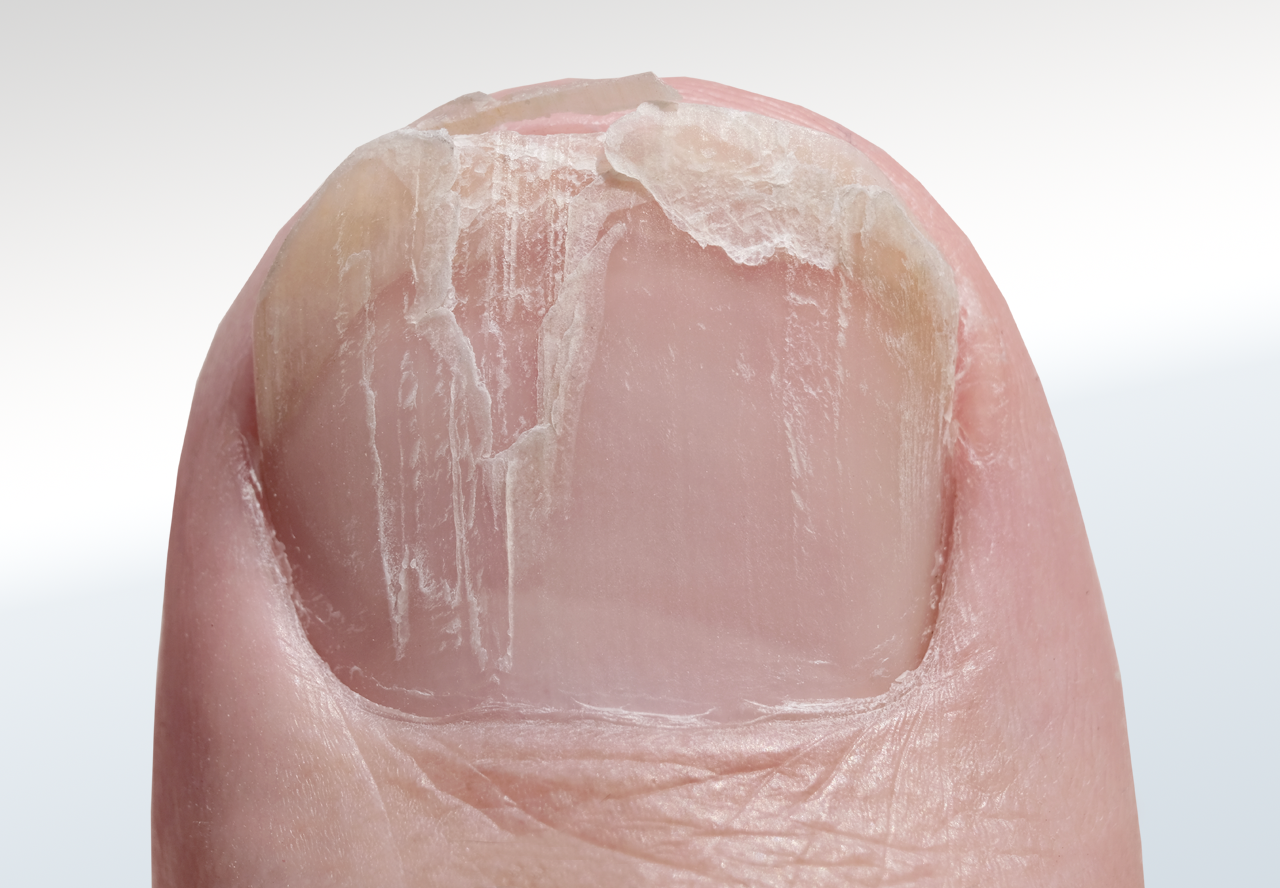 Brittle Nails Relieve Foot Pain & Leg Pain