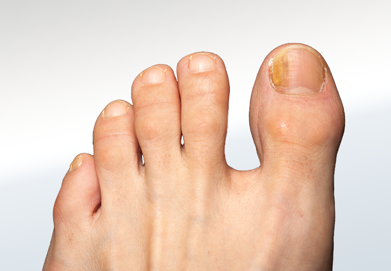 Fungal Relieve Foot Pain & Leg Pain