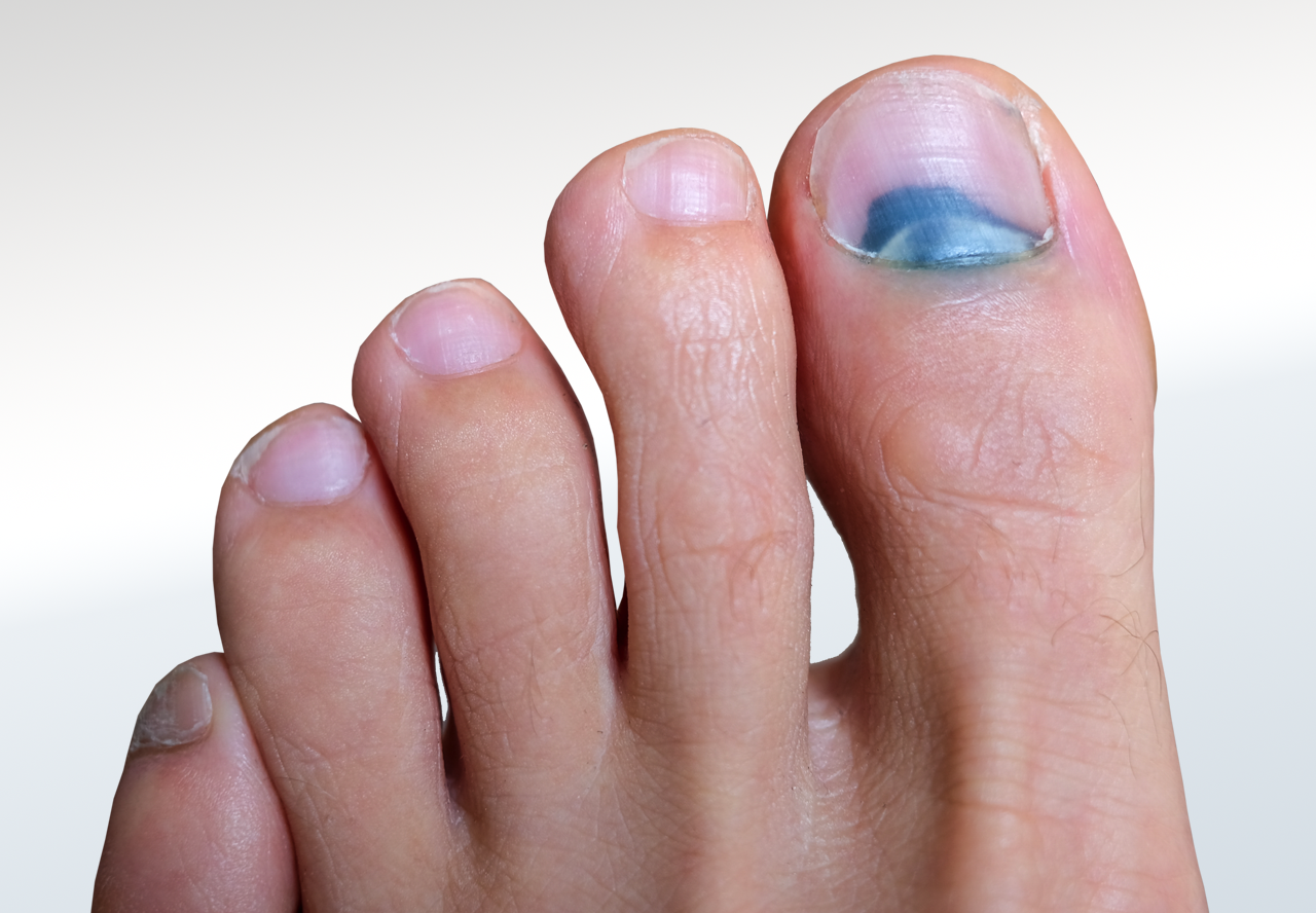 Injury/Trauma Relieve Foot Pain & Leg Pain