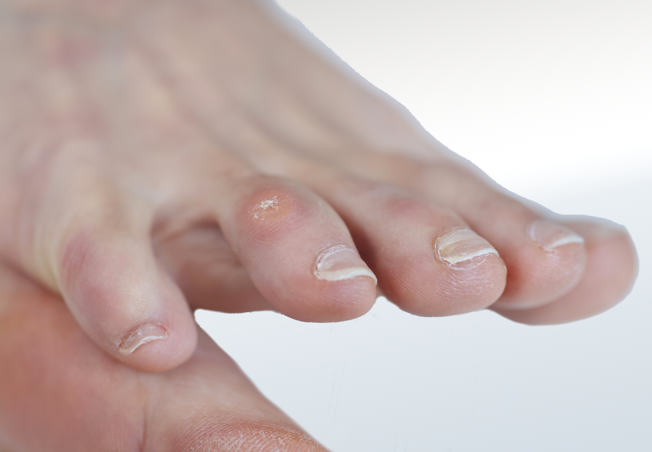 Corns Relieve Foot Pain & Leg Pain