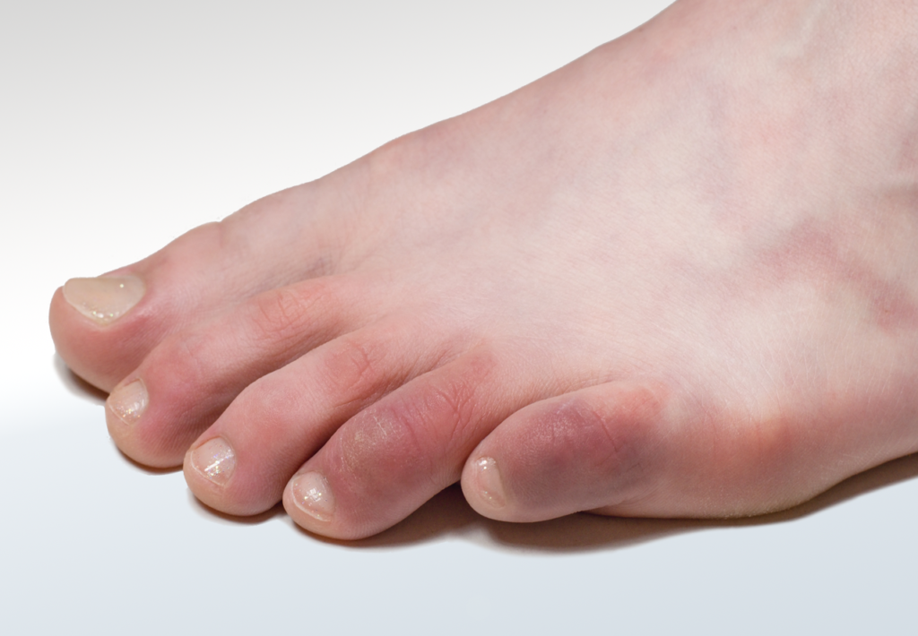 Covid Toes