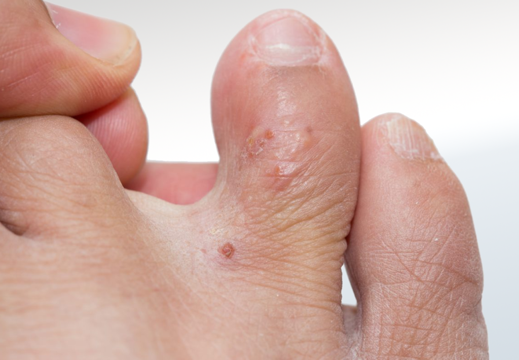 Eczema