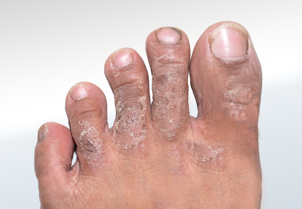 Psoriasis