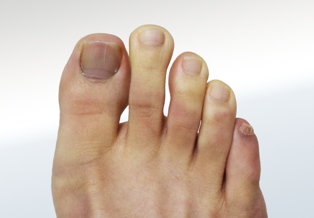 Raynaud’s Disease