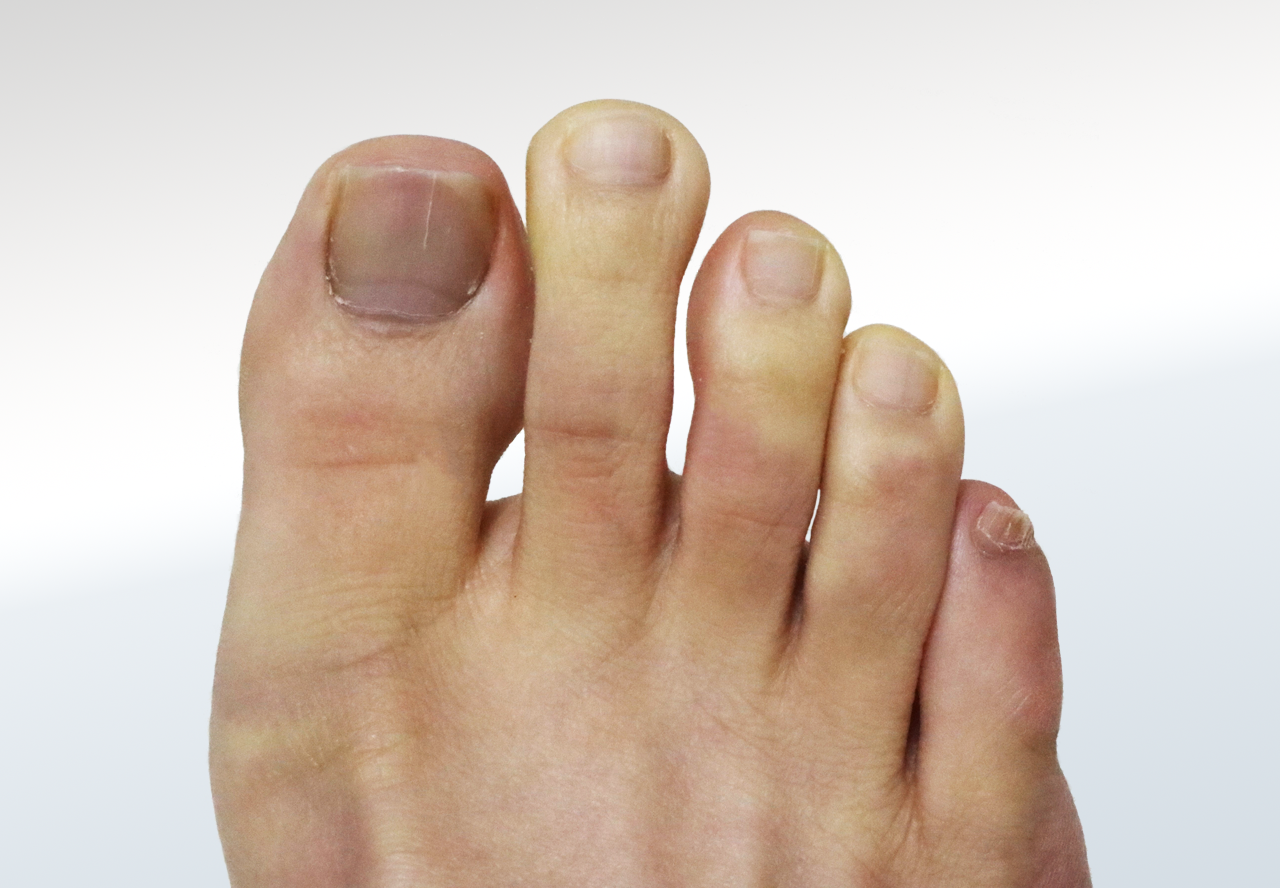 Raynaud’s Disease Relieve Foot Pain & Leg Pain