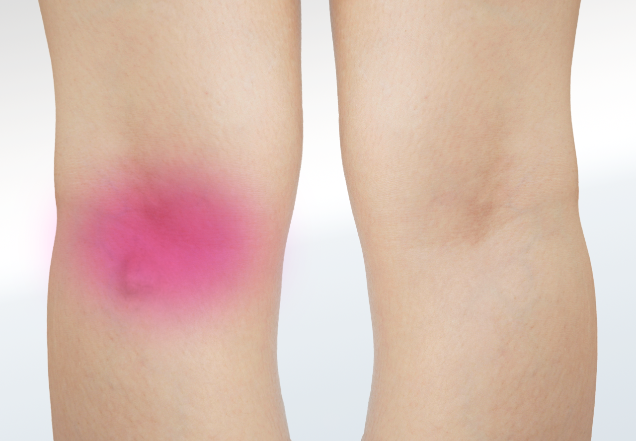 Baker’s Cyst Relieve Foot Pain & Leg Pain