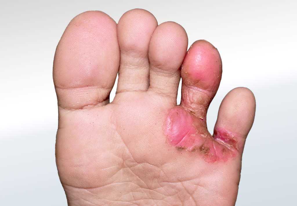 Bacterial Infection