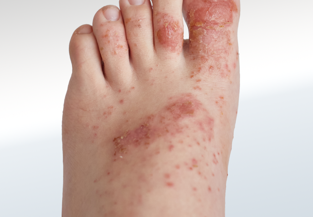 Rash