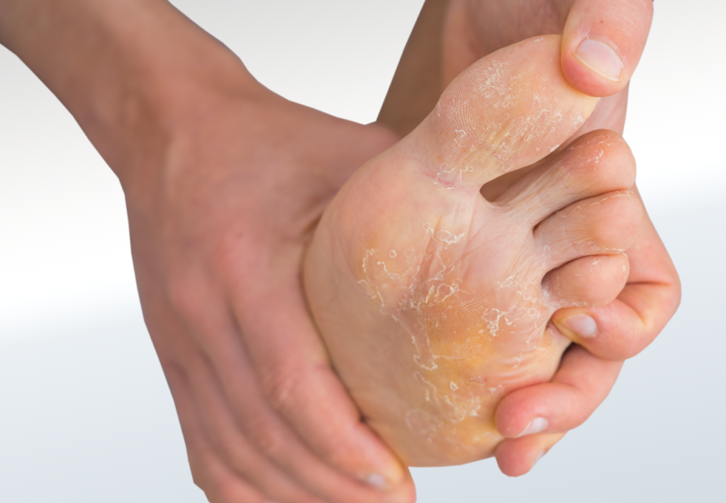 Fungal Infection