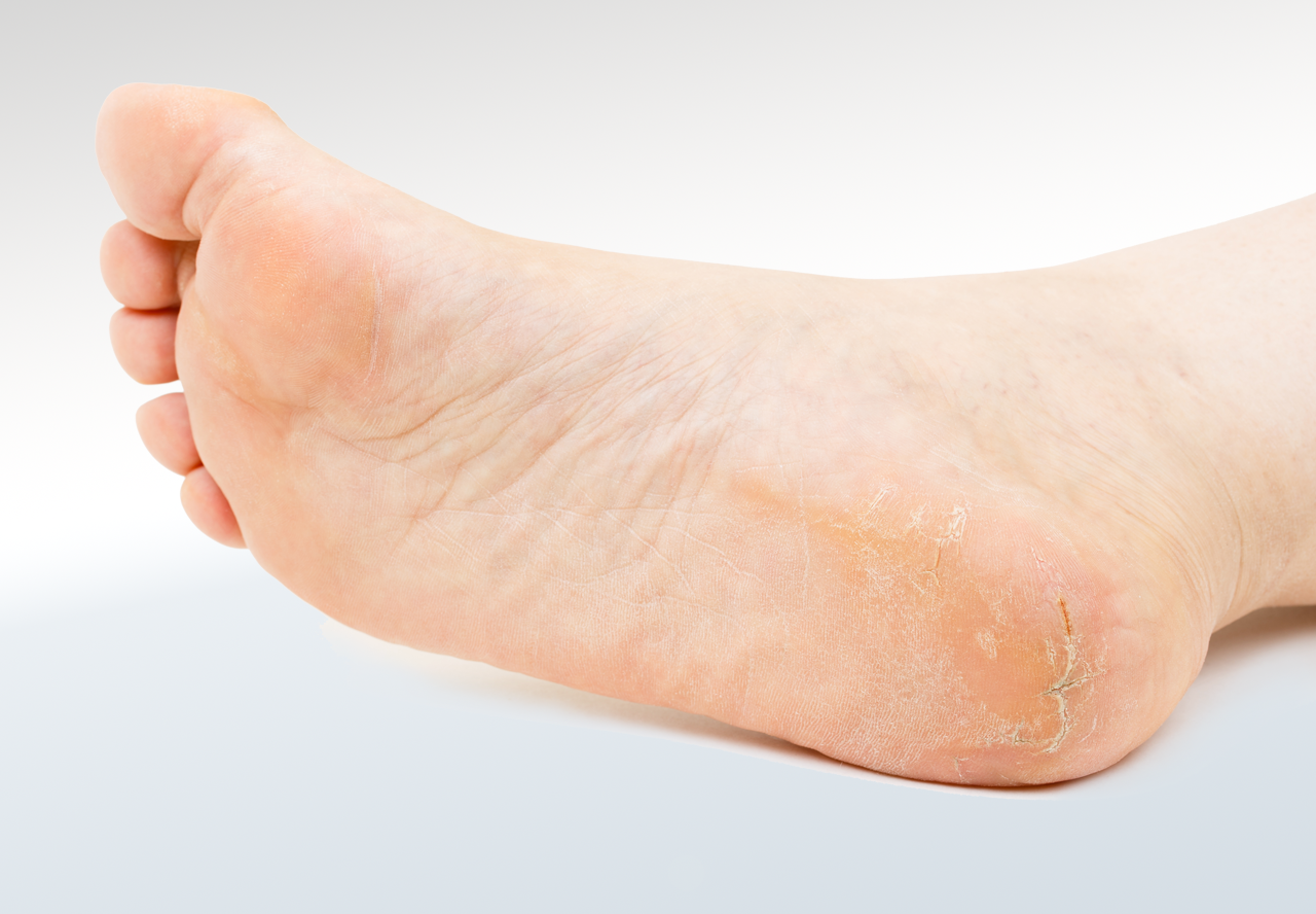 Callus Relieve Foot Pain & Leg Pain
