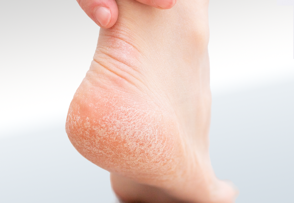 Skin Conditions Foot Heel Relieve Foot Pain Leg Pain
