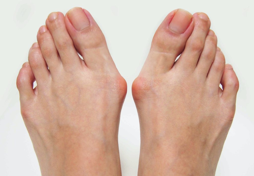 Bunion