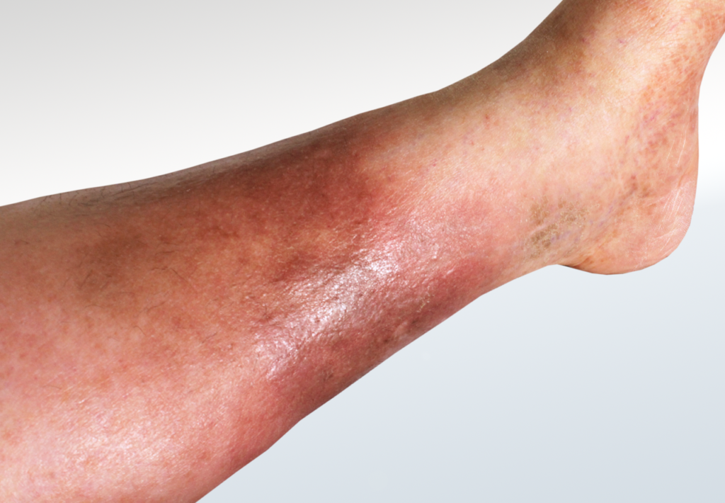 Cellulitis
