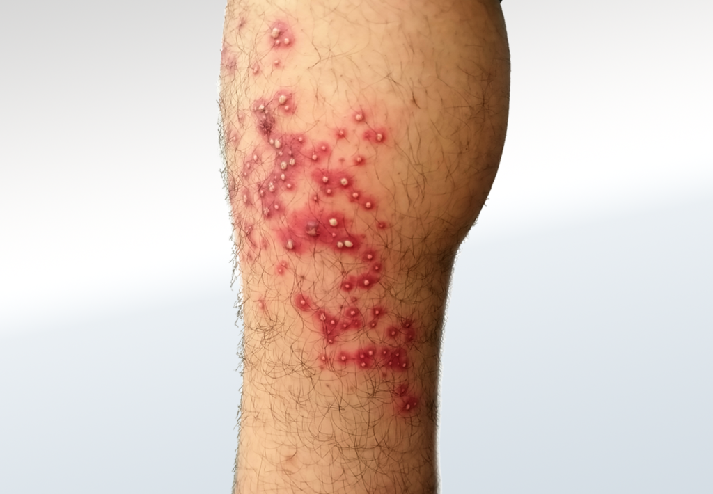 Folliculitis
