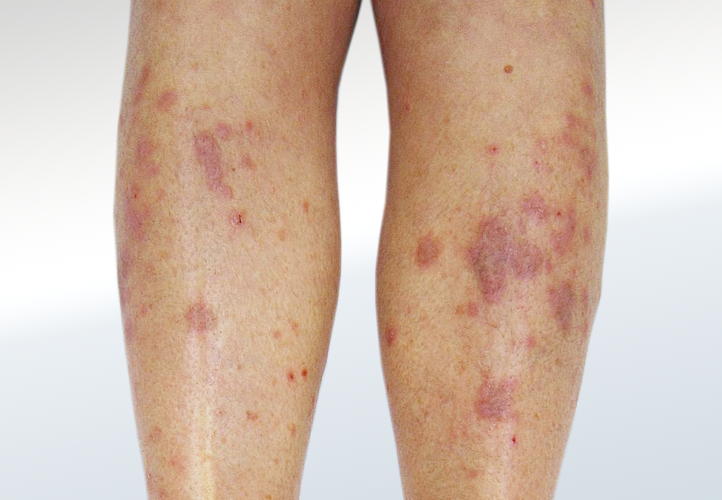 Lichen Planus