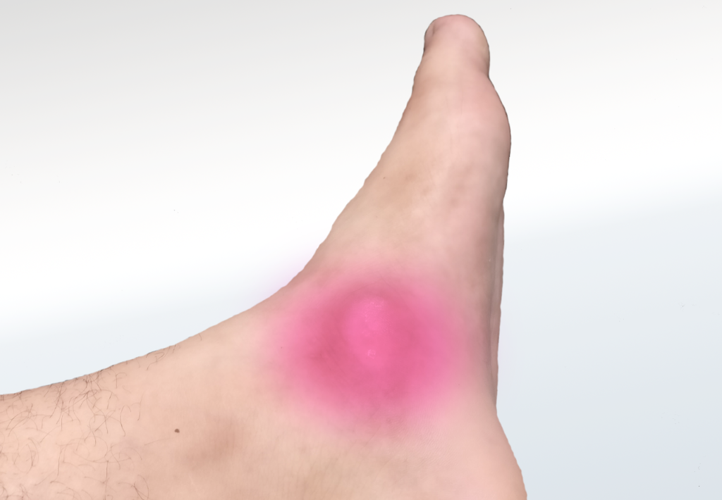 Accessory Bone/Navicular Syndrome