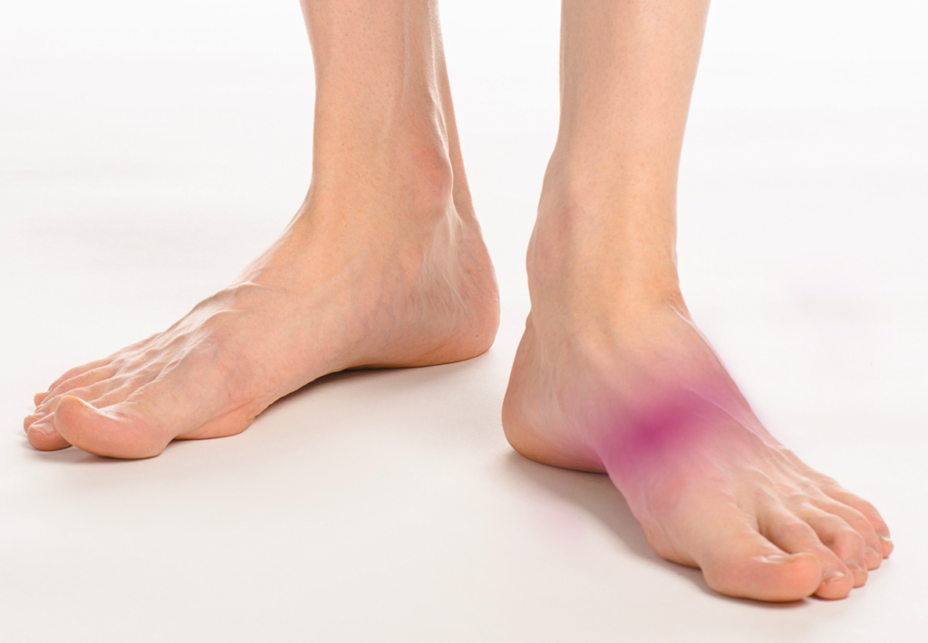 Midfoot Impingement Syndrome