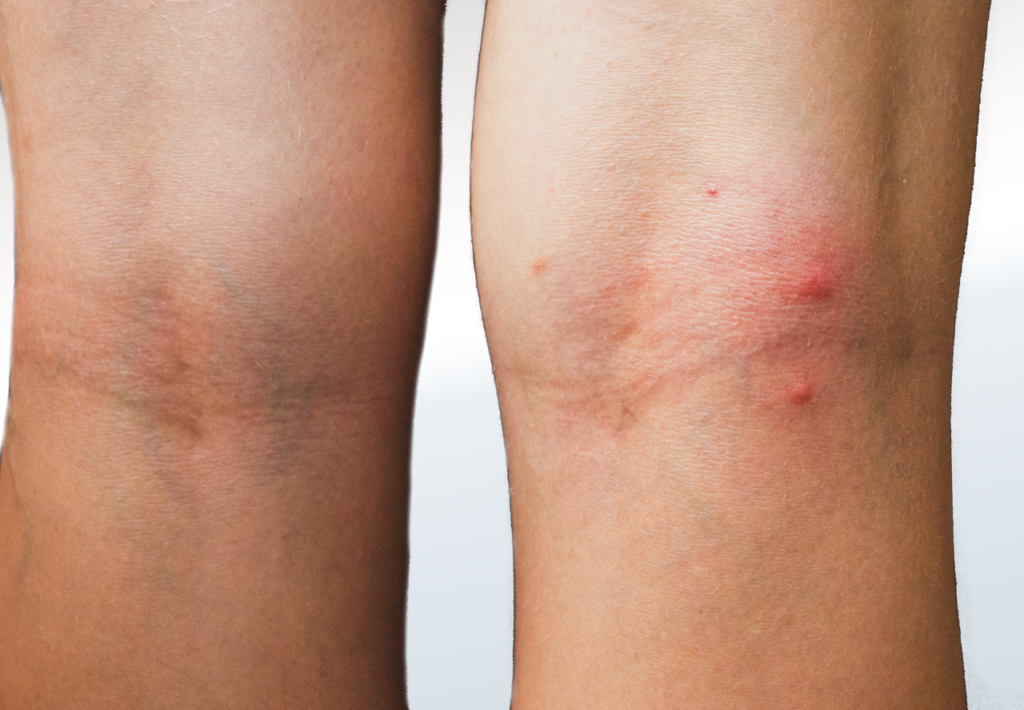 Bug Bites