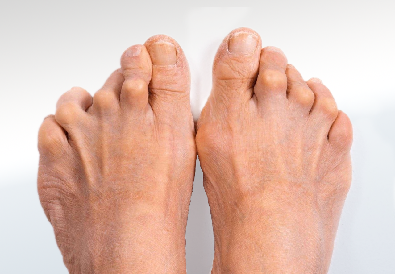 Arthritis Relieve Foot Pain & Leg Pain