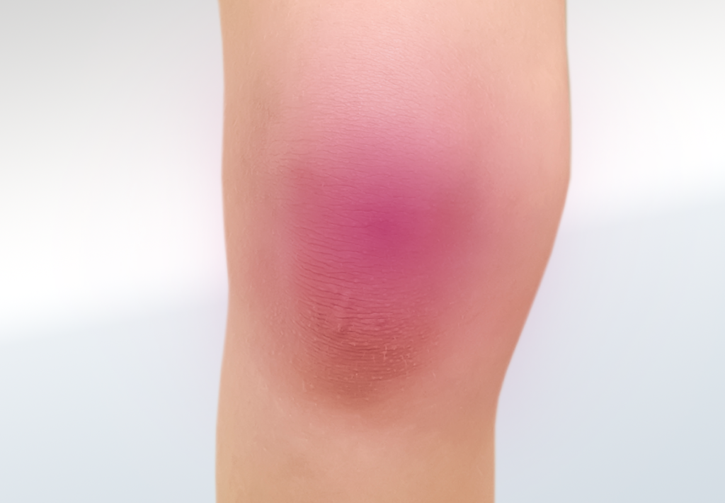 Arthritis