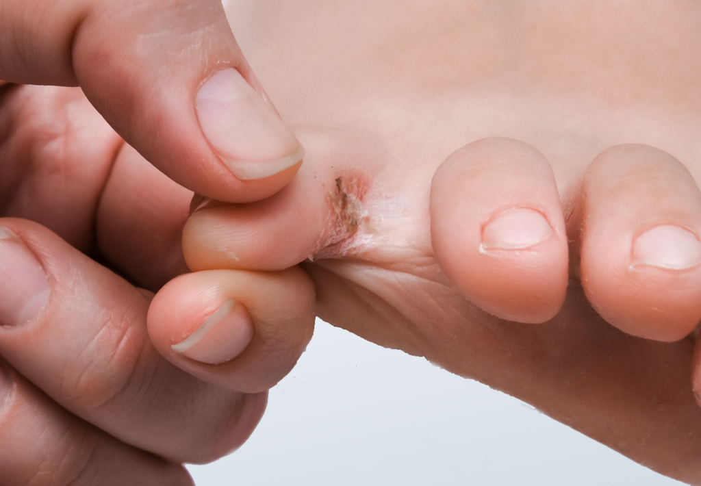 Eczema