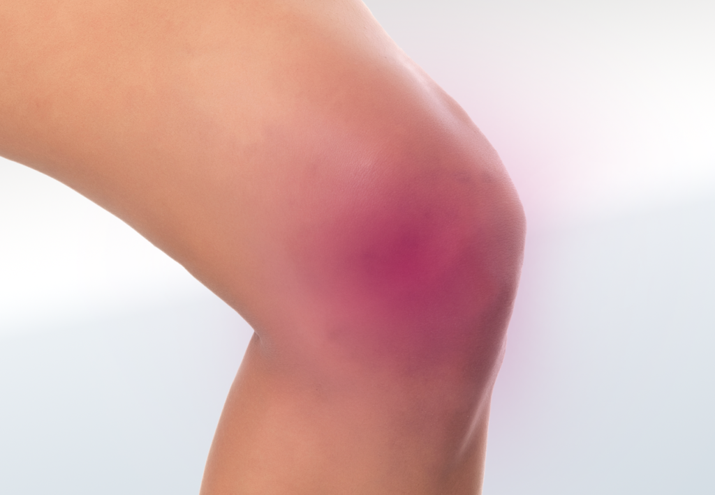Arthritis