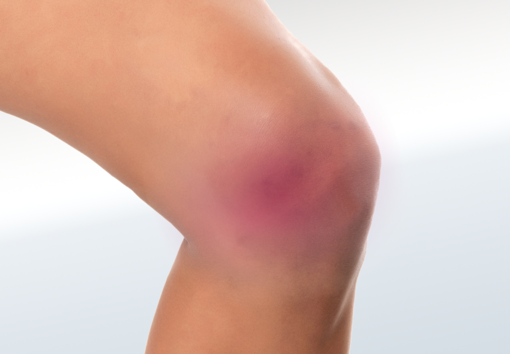 Knee Meniscal Tear