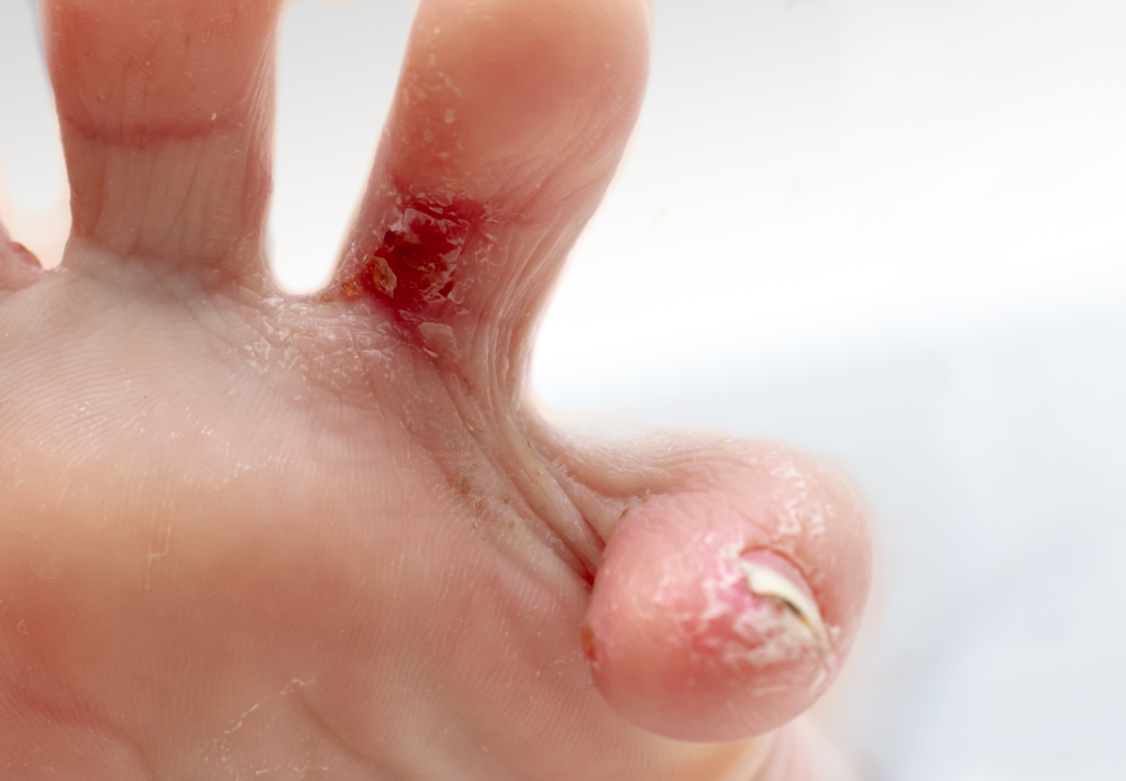 Eczema