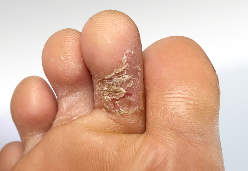 Psoriasis