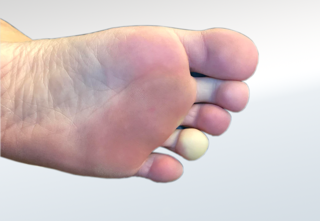 Raynaud’s Disease