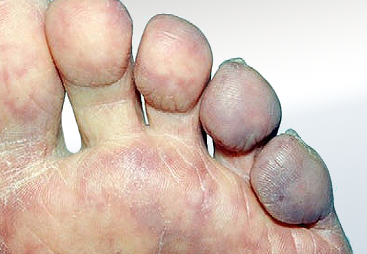 Shower Emboli Relieve Foot Pain & Leg Pain