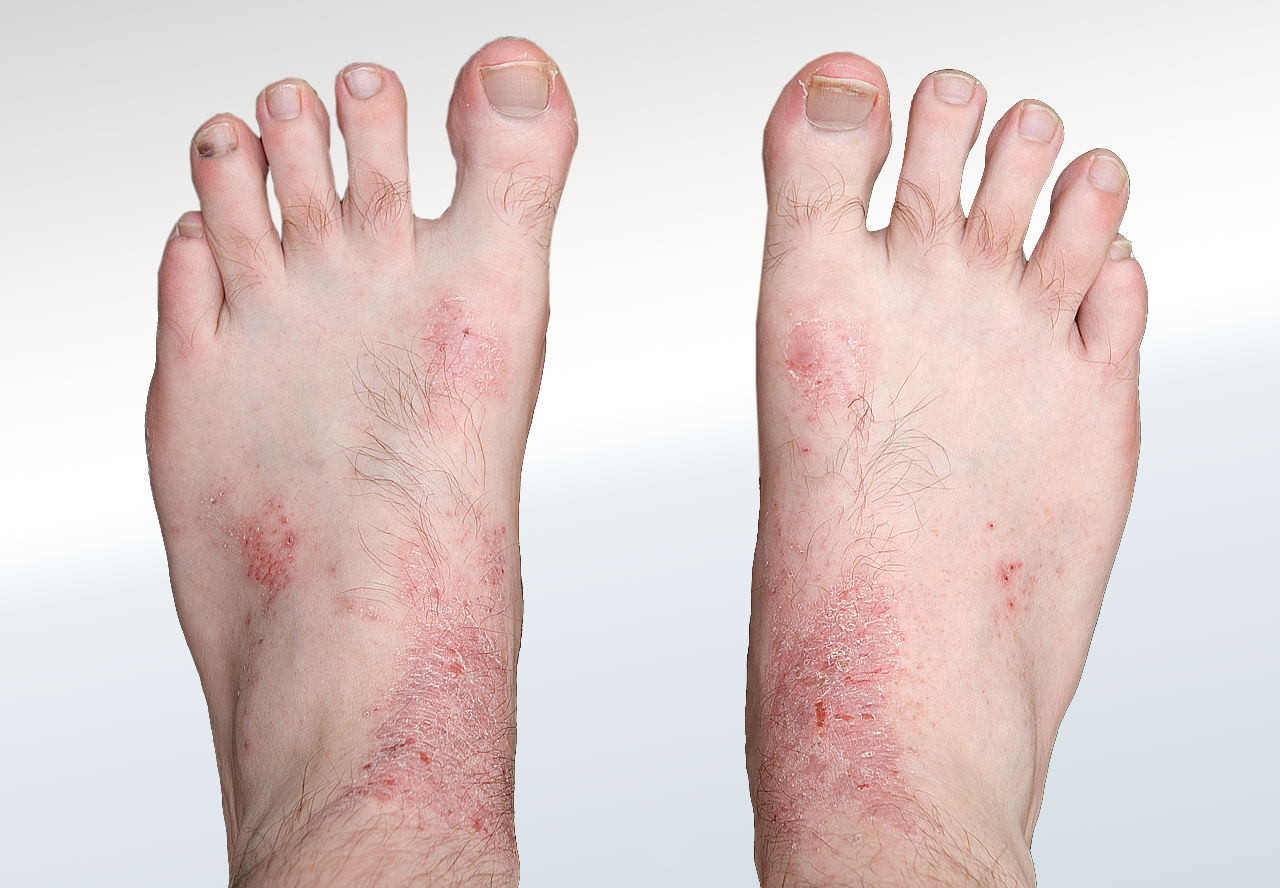 Eczema Relieve Foot Pain And Leg Pain