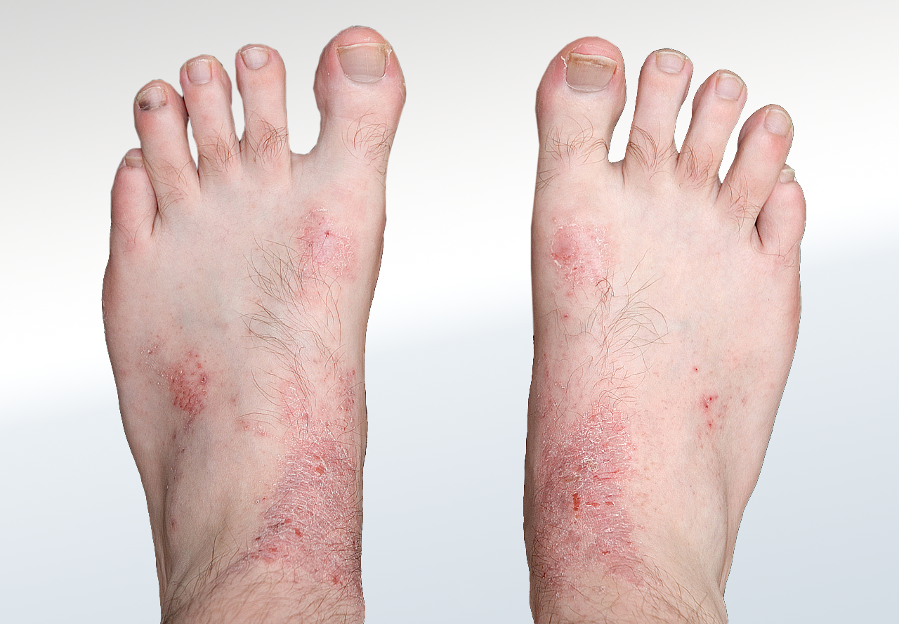Eczema Relieve Foot Pain Leg Pain