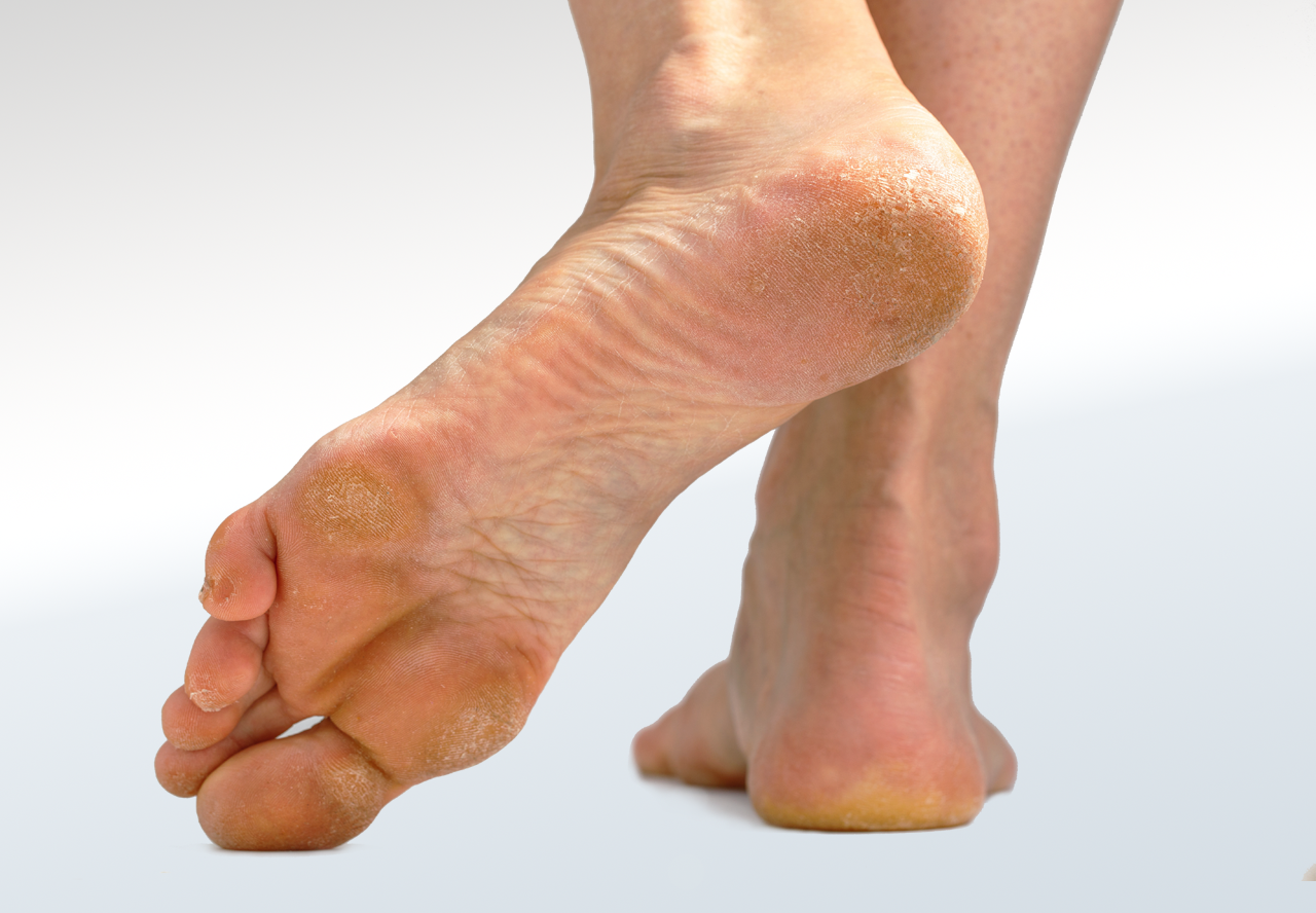 Callus Relieve Foot Pain & Leg Pain