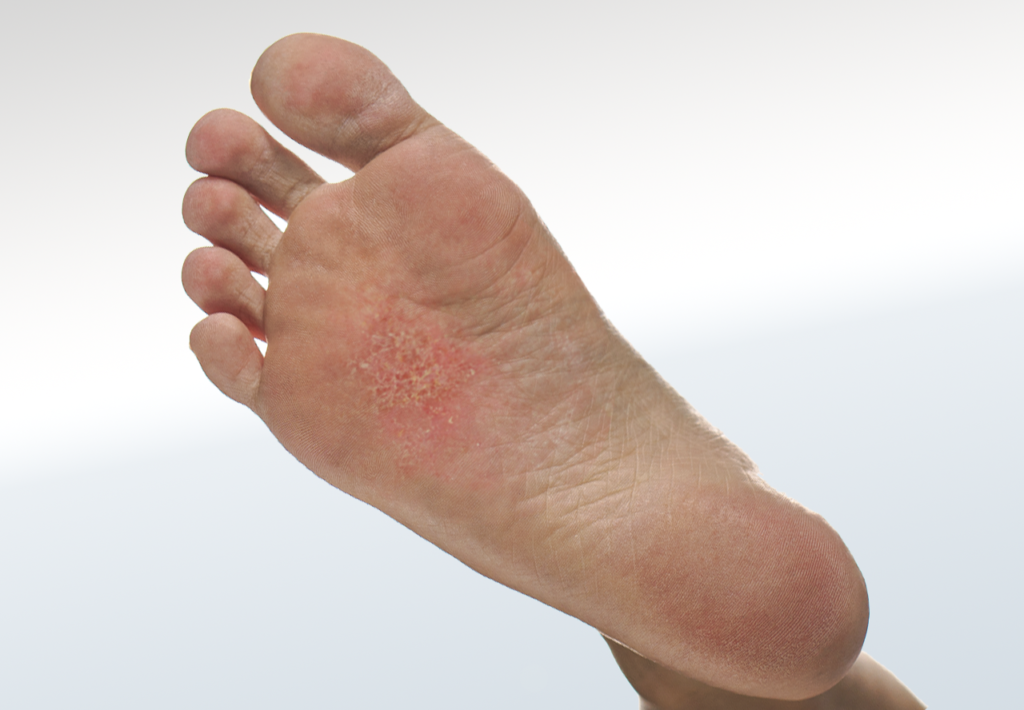 Eczema