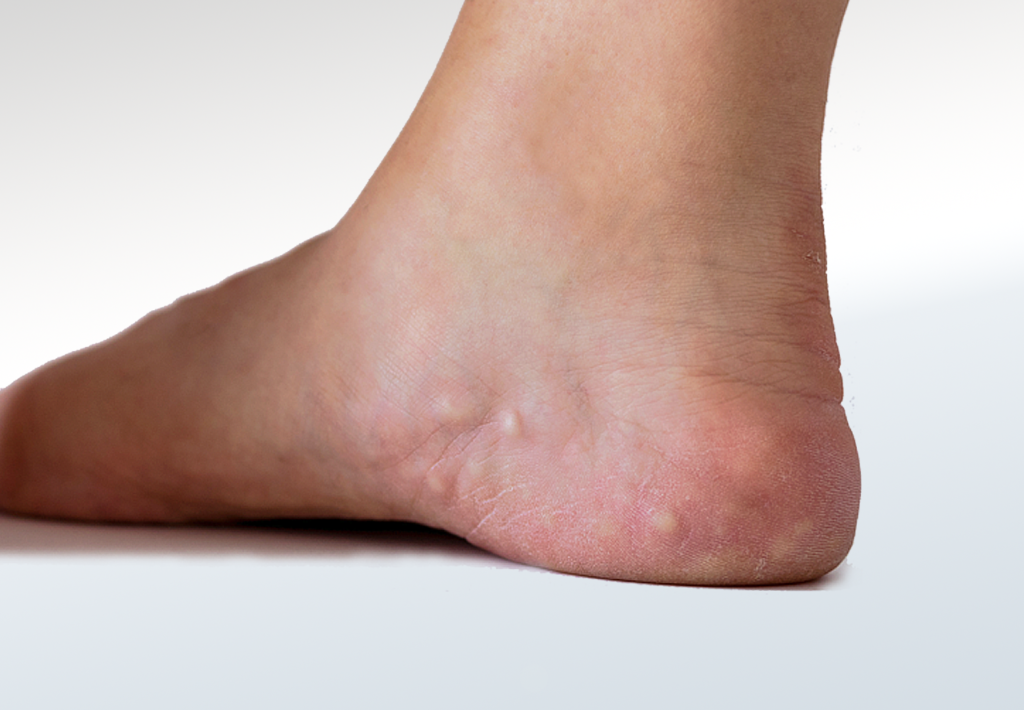Piezogenic Papules