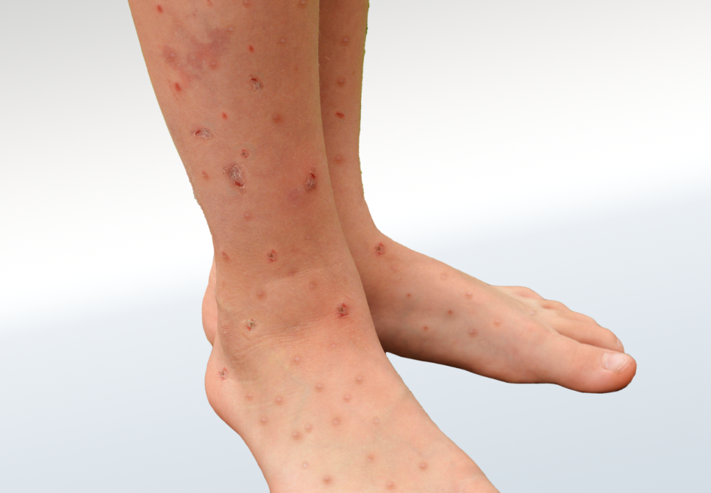Bug Bites