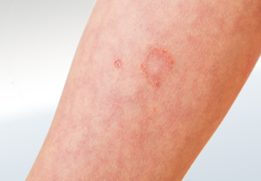 Contact Dermatitis