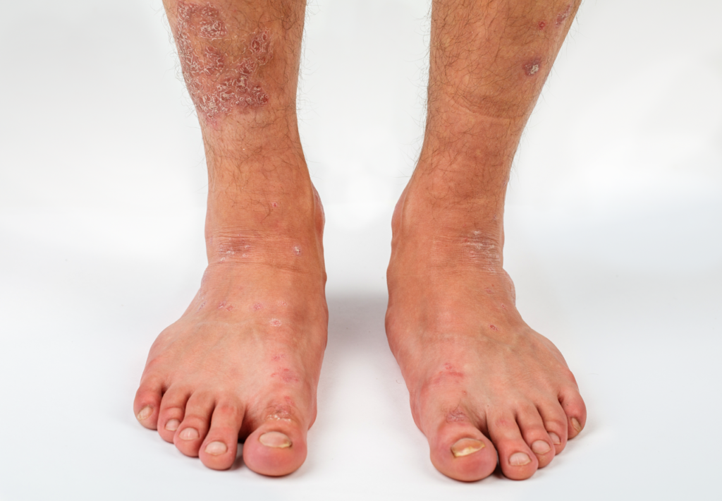 Eczema