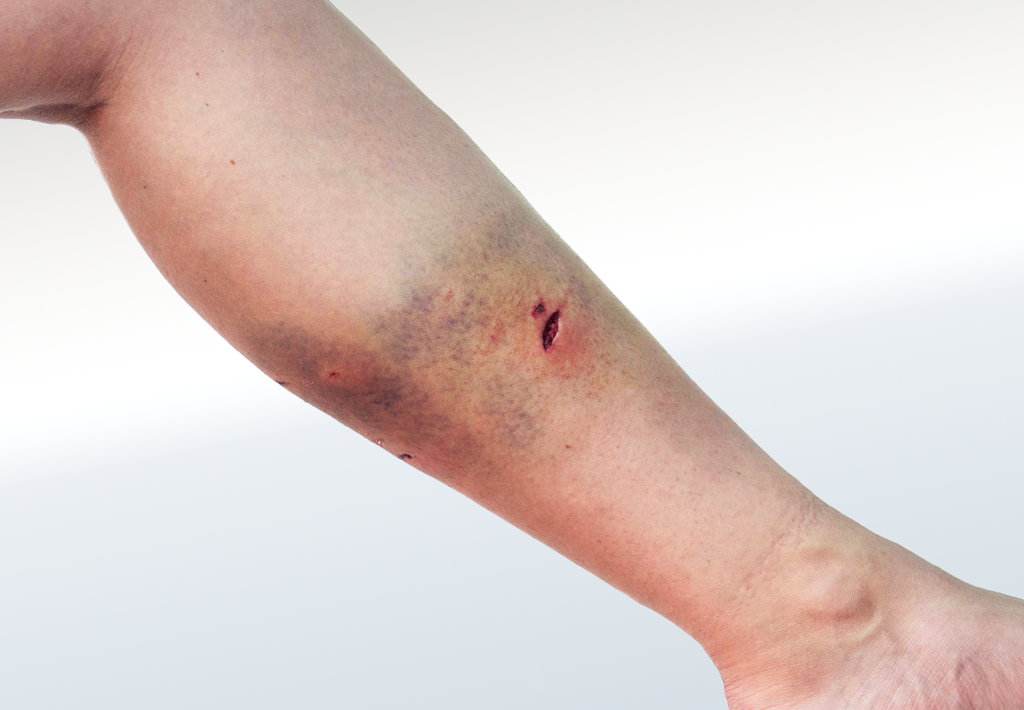 Wound