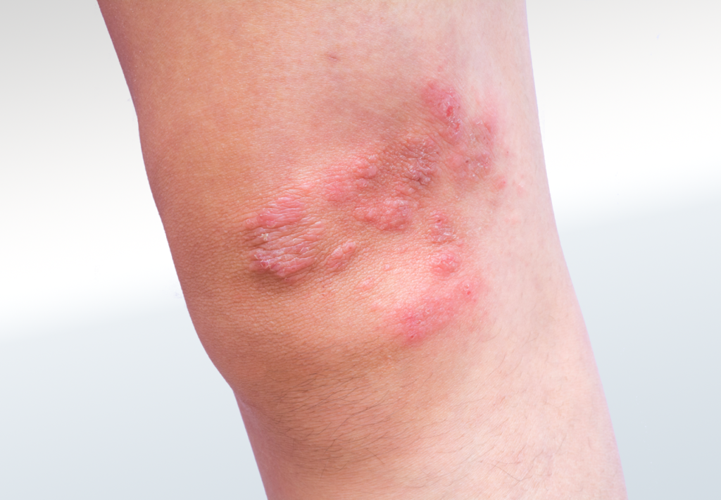 Eczema