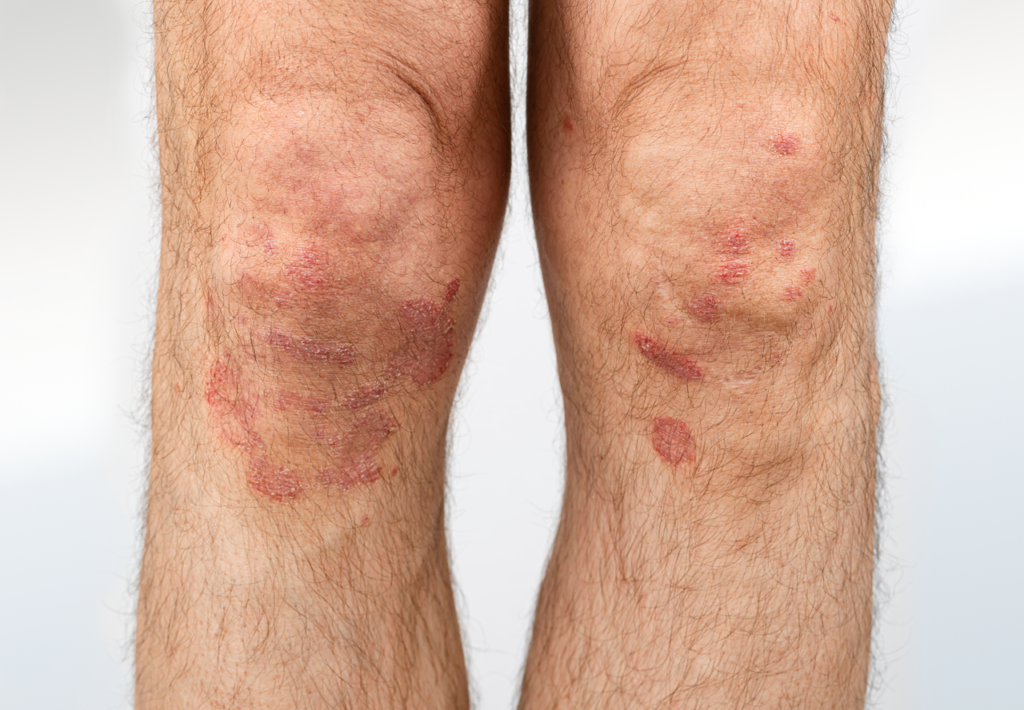 Psoriasis