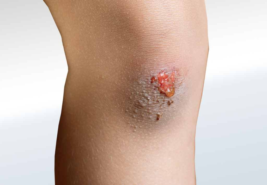 Wound
