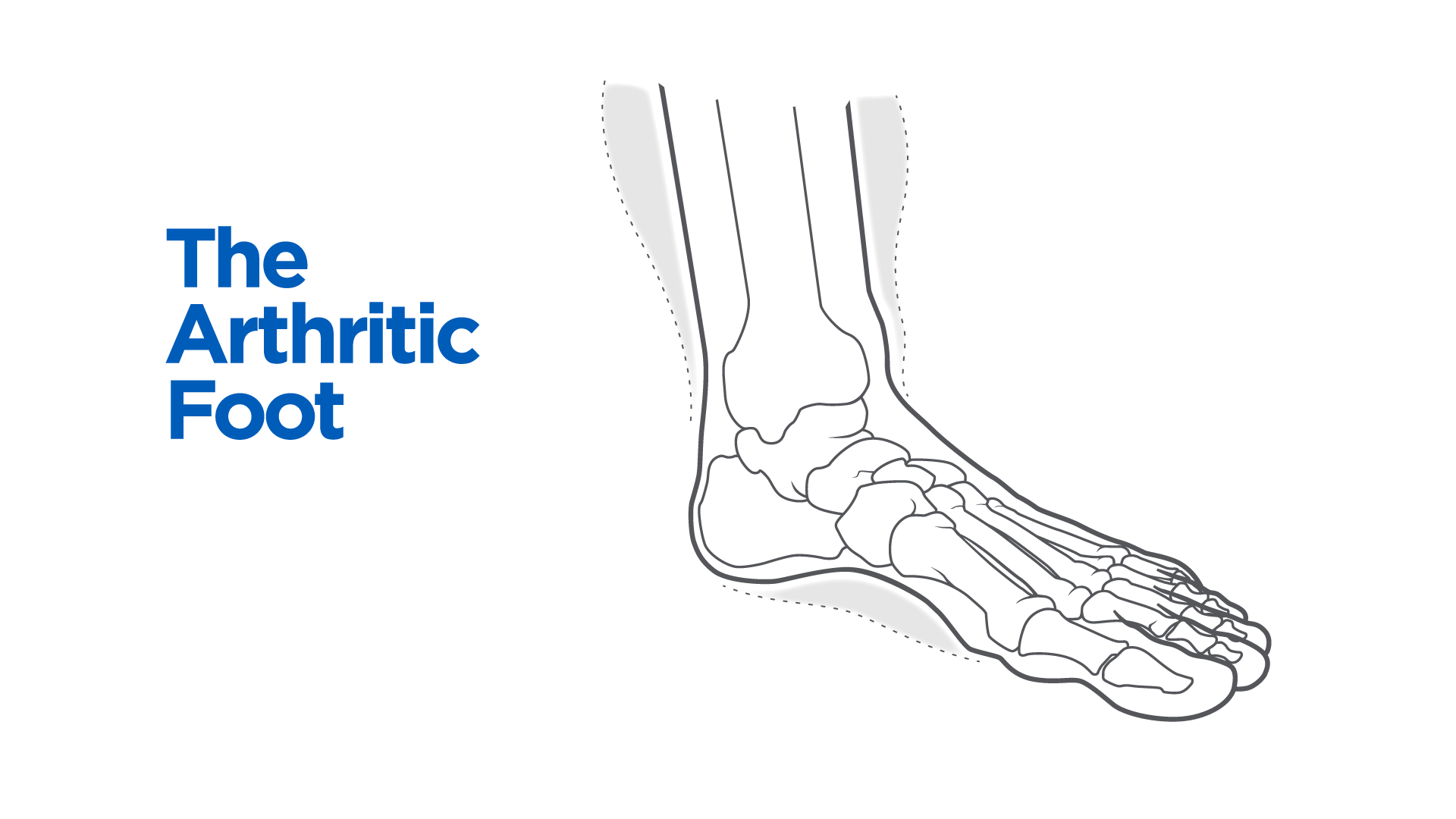 The Arthritic Foot