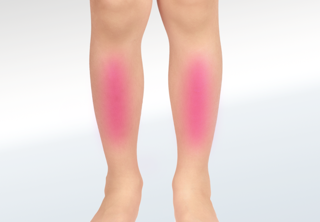 Shin Splints