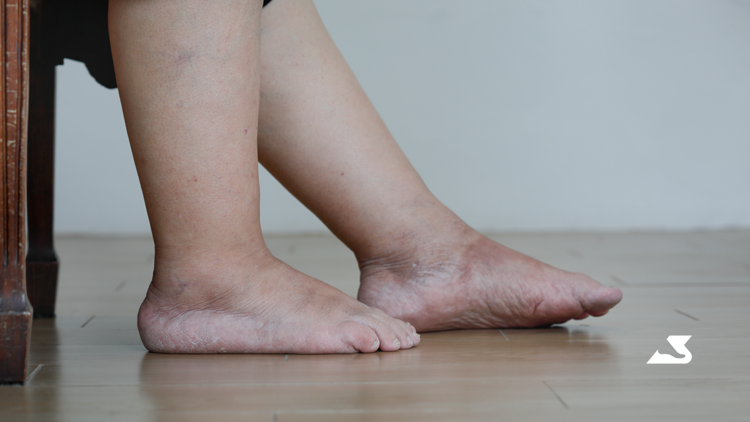 Everything you need to know about swelling in your legs